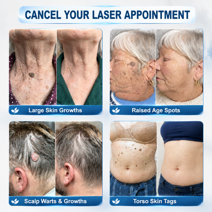 USA | 𝐇𝐈𝐒𝐊𝐈𝐍®👩‍⚕️ 𝟕-𝐃𝒂𝘆 𝐒𝗸𝐢𝐧 𝐓𝒂𝗴 & 𝐒𝐩𝙤𝐭 𝐄𝐫𝒂𝐬𝙚𝐫 Painless & Scar-Free Advanced Imperfection Removal Rollerball Pen