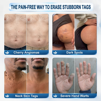 USA | 𝐇𝐈𝐒𝐊𝐈𝐍®👩‍⚕️ 𝟕-𝐃𝒂𝘆 𝐒𝗸𝐢𝐧 𝐓𝒂𝗴 & 𝐒𝐩𝙤𝐭 𝐄𝐫𝒂𝐬𝙚𝐫 Painless & Scar-Free Advanced Imperfection Removal Rollerball Pen