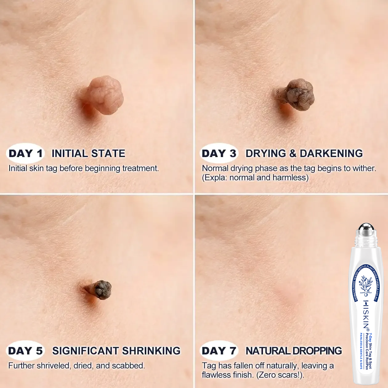 USA | 𝐇𝐈𝐒𝐊𝐈𝐍®👩‍⚕️ 𝟕-𝐃𝒂𝘆 𝐒𝗸𝐢𝐧 𝐓𝒂𝗴 & 𝐒𝐩𝙤𝐭 𝐄𝐫𝒂𝐬𝙚𝐫 Painless & Scar-Free Advanced Imperfection Removal Rollerball Pen